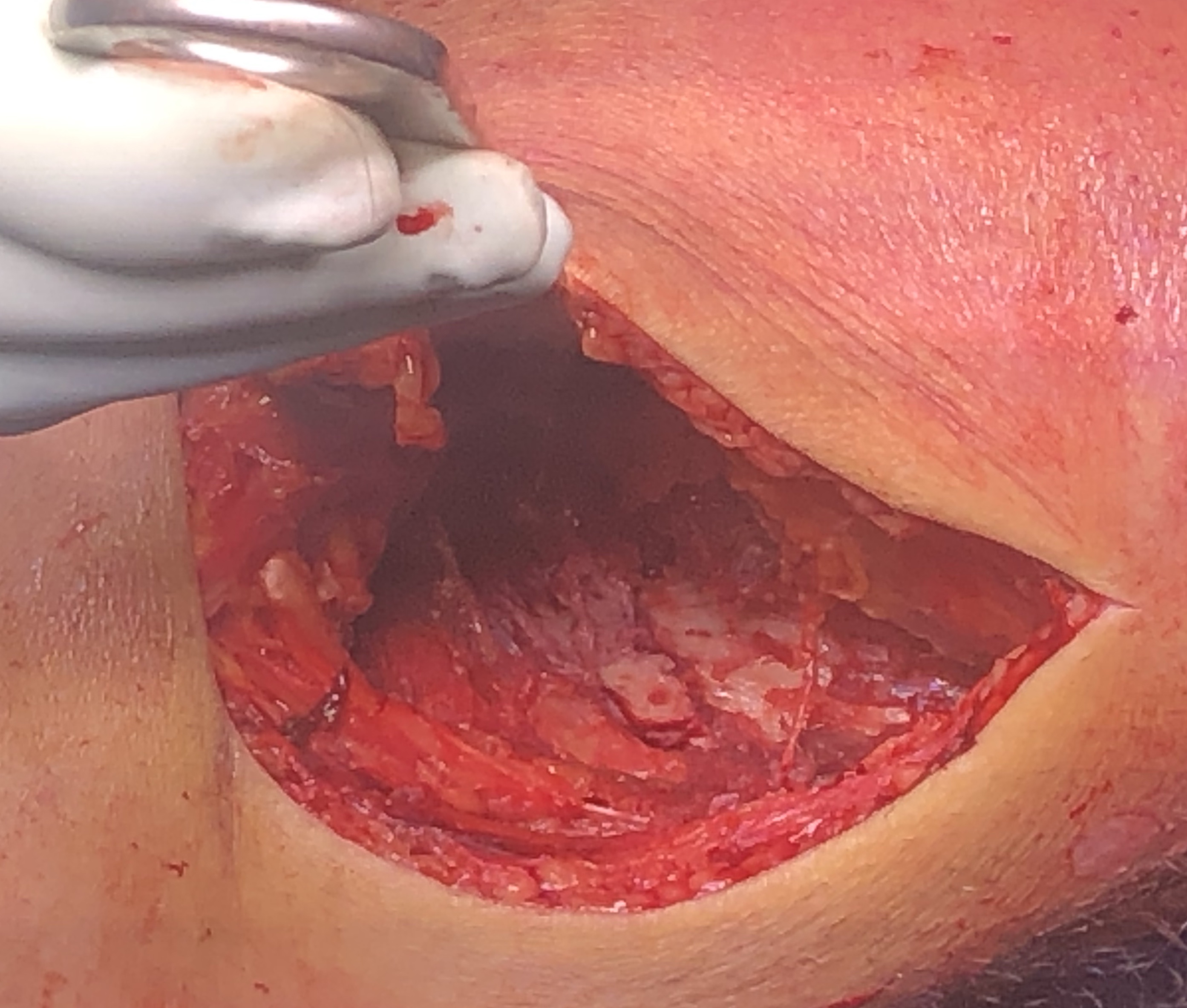 Posteromedial approach knee 3